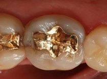 Inlay Gold